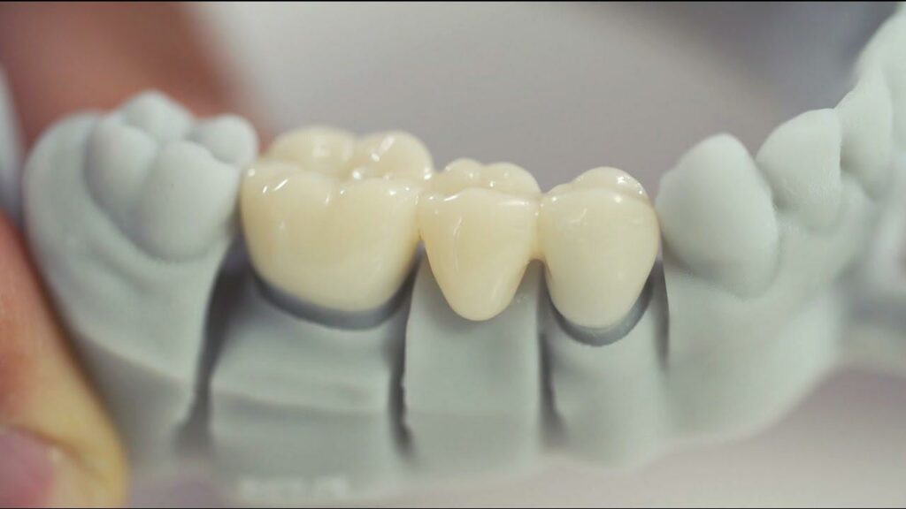 Revolutionize Your Smile With 3D Printer Dental Crowns